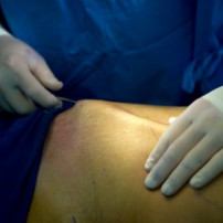 Liposuctie: de operatie