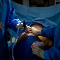 Liposuctie of liposculptuur