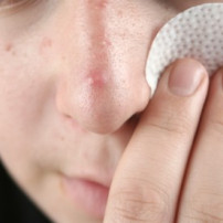 Behandeling acne