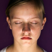 Oorzaak acne