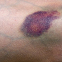 Blauwe plekken