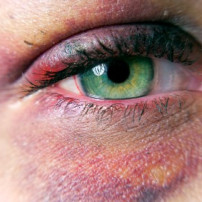 is rosacea besmettelijk