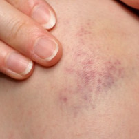 Soorten bloeduitstortingen of hematomen
