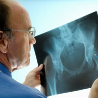 Osteoporose