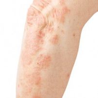 Psoriasis