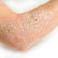 Oorzaken van psoriasis