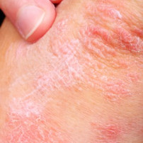 Soorten psoriasis
