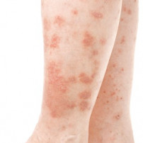 Symptomen psoriasis