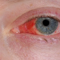 Bindvliesontsteking of conjunctivitis