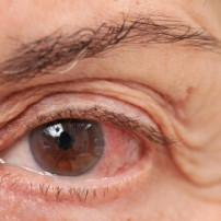 Symptomen bindliesontsteking of conjunctivitis