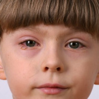 Oorzaken bindvliesontsteking of conjunctivitis