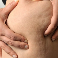 Lipolyse tegen cellulite