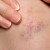 Soorten bloeduitstortingen of hematomen