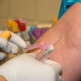 Voorbereiding gastric bypass