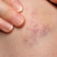 Soorten bloeduitstortingen of hematomen