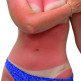 Symptomen van zonneallergie