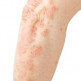 Psoriasis