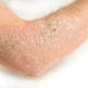 Oorzaken van psoriasis