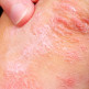Soorten psoriasis