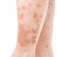 Symptomen psoriasis