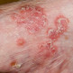 Voorkomen psoriasis