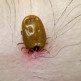 Ziekte van Lyme voorkomen