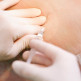 Epidurale verdoving: hoe gaat het in zijn werk?