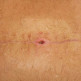 Symptomen van MRSA of ziekenhuisbacterie