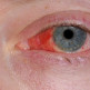 Bindvliesontsteking of conjunctivitis